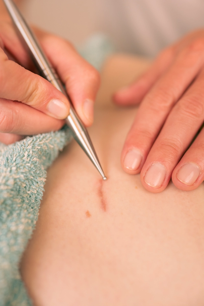 Handtherapie mit Narbenhandlung bei Kristina Wagner in Graz